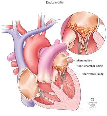 Heart valve infected with bacterial endocarditis 