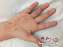 Osler Nodes on the extremities of a patient with bacterial endocarditis